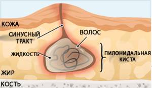 Методы диагностики кисты копчика Последствия копчиковой кисты