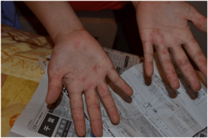 Сыпь на руках Сыпь на руках между пальцами