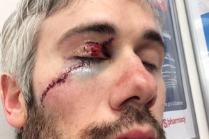 Из-за чего может появиться невралгия лицевого нерва Возможные причины невралгии лицевого нерва