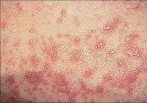 Лечение народными средствами Как вывести лишай народными средствами Чем можно вылечить лишай