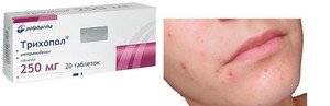 Описание препарата Трихопол и форма выпуска Трихопол против прыщей