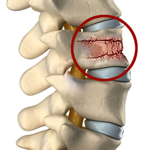 Особенности перелома поясничного отдела позвоночника Перелом поясничного отдела позвоночника