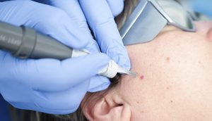 Хирургическое удаление Хирургическое удаление дерматофибромы