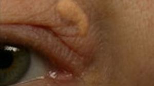 Разновидности ксантом ксантоматозные бляшки