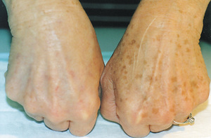 Удаление летинго Как удалить лентиго