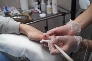 Удаление папилломы жидким азотом Как удалить папиллому