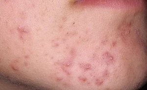 Угри на подбородке Угри на подбородке у подростка