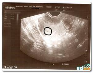 Акушерский срок беременности 3 недели после зачатия