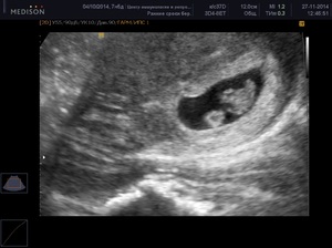 УЗИ на ранних сроках беременности УЗИ при беременночсти