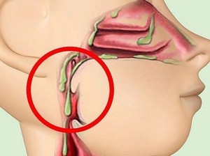 Мокрота в горле Слизь в горле