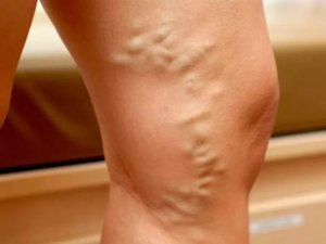 Варикоз Варикоз на ногах