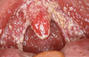 Варикоз половых губ лечение Варикоз половых губ - что это такое