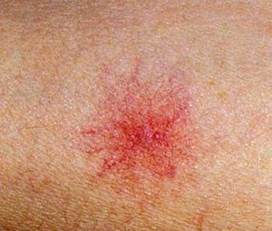 Красные пятна на ногах Возможные причины появления пятен на ногах