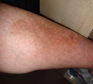 Тип пятен на ногах Характер красных пятен на ногах