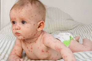 Ветрянка у детей до года Ветрянка у детей грудного возраста