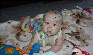 Инкубационный период ветрянки Ветряная оспа - заболевание вирусное