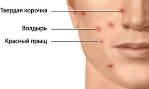 Лечебная терапия при заражении вирусом ветрянки Лечебная терапия при заражении ветрянкой