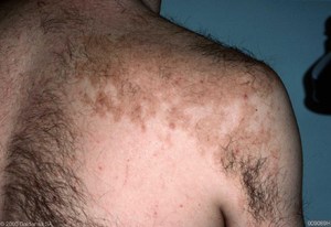 Лечение невуса Беккера Как лечить невус Беккера