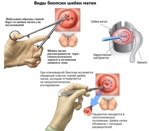 Виды биопсии шейки матки Виды биопсии шейки матки при эрозии