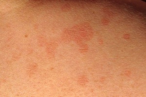 Отрубевидный лишай у человека Отрубевидный лишай