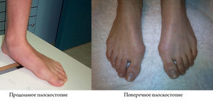 Поперечное плоскостопие Плоскостопие у детей и взрослых