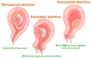 Какие осложнения могут быть Как может осложнится состояние