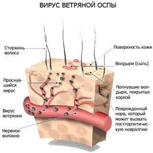Вирус ветряной оспы - наглядная схема Вирус ветряной оспы и его проявления