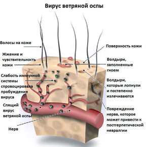 Вирус ветряной оспы - особенности Возбудитель ветряной оспы - схема
