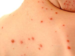 Тяжелая форма ветряной оспы Тошнота при ветрянке у взрослых