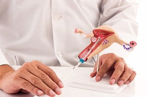 Введение спирали Введение спирали в полость матки