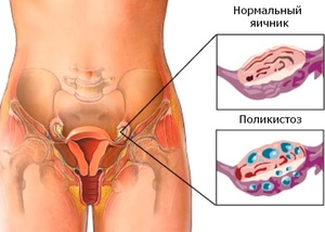 Причины поликистоза яичников Как лечить поликистоз яичников у женщины
