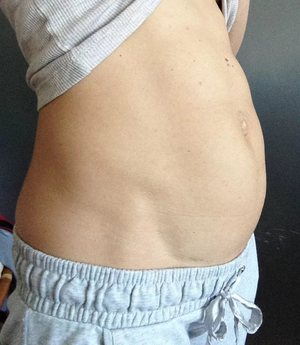 Вздутие живота Вздутие живота после еды