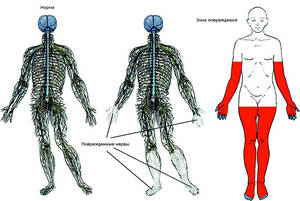 Лечение нейропатии Как лечить нейропатию конечностей