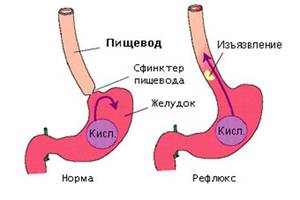Народные средства лечения рефлюкса Народные средства лечения рефлюкса