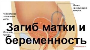 Загиб матки и беременность Загиб матки и беременность у женщины