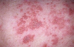 Симптомы опоясывающего лишая Чем лечат лишай на теле