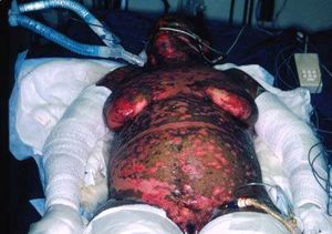 Женщина с синдромом Лайелла - острая форма Женщина с синдромом Лайелла - фото острой формы заболевания