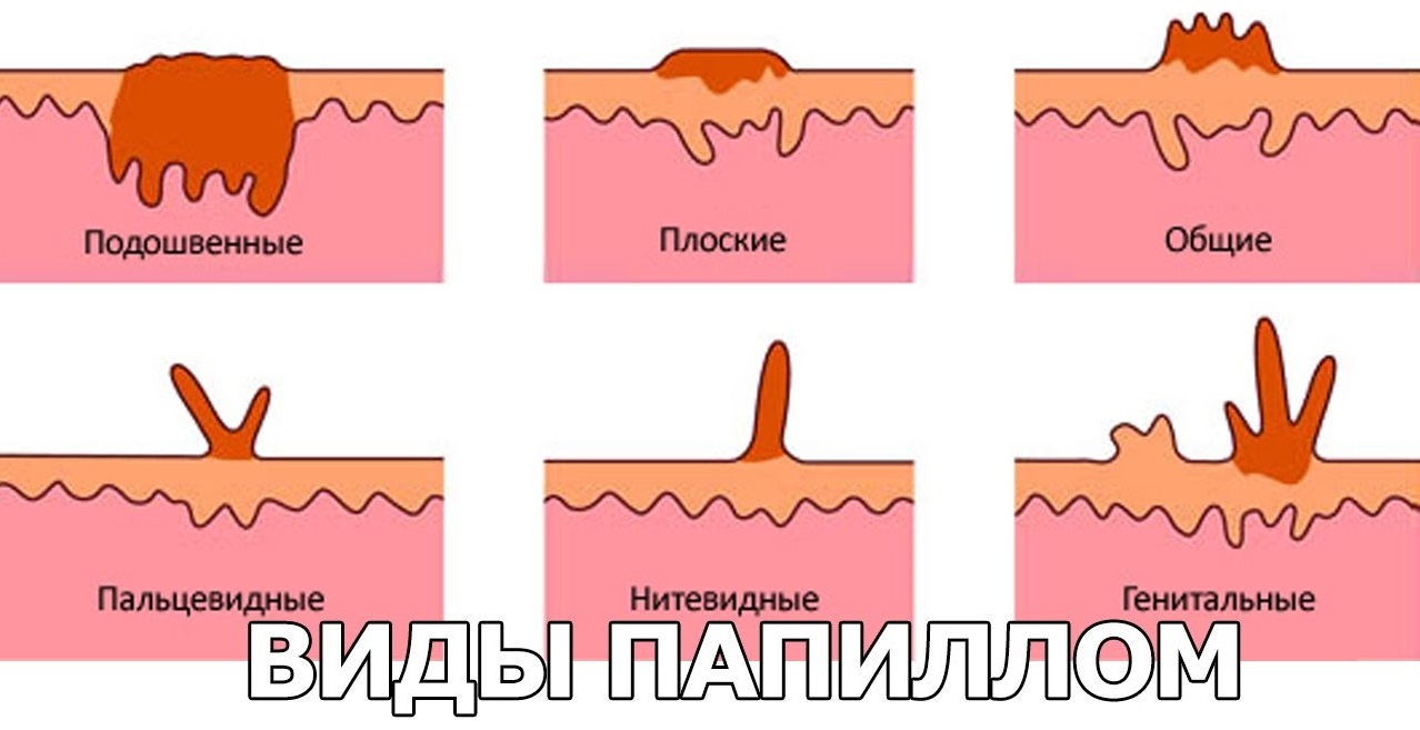 Виды папиллом
