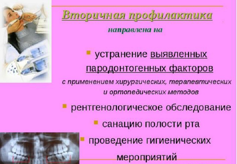 Вторичная профилактика пародонтоза