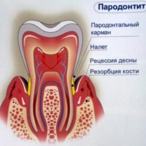 Пародонтит