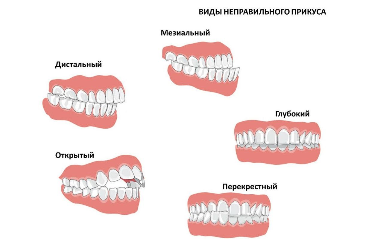 Виды неправильного прикуса