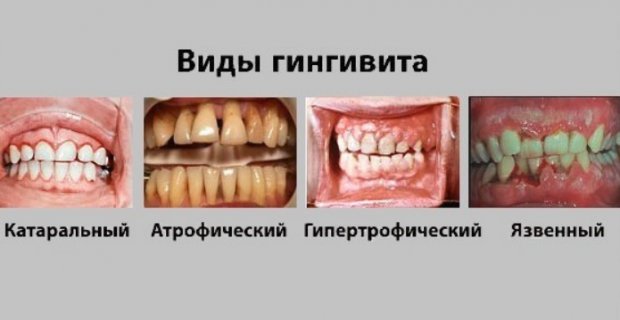 Виды гингивита
