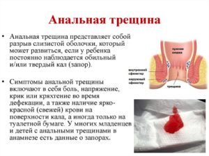 Лечение и диета при анальной трещине