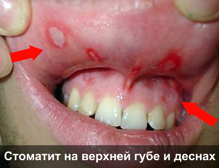 Стоматит на губе и деснах