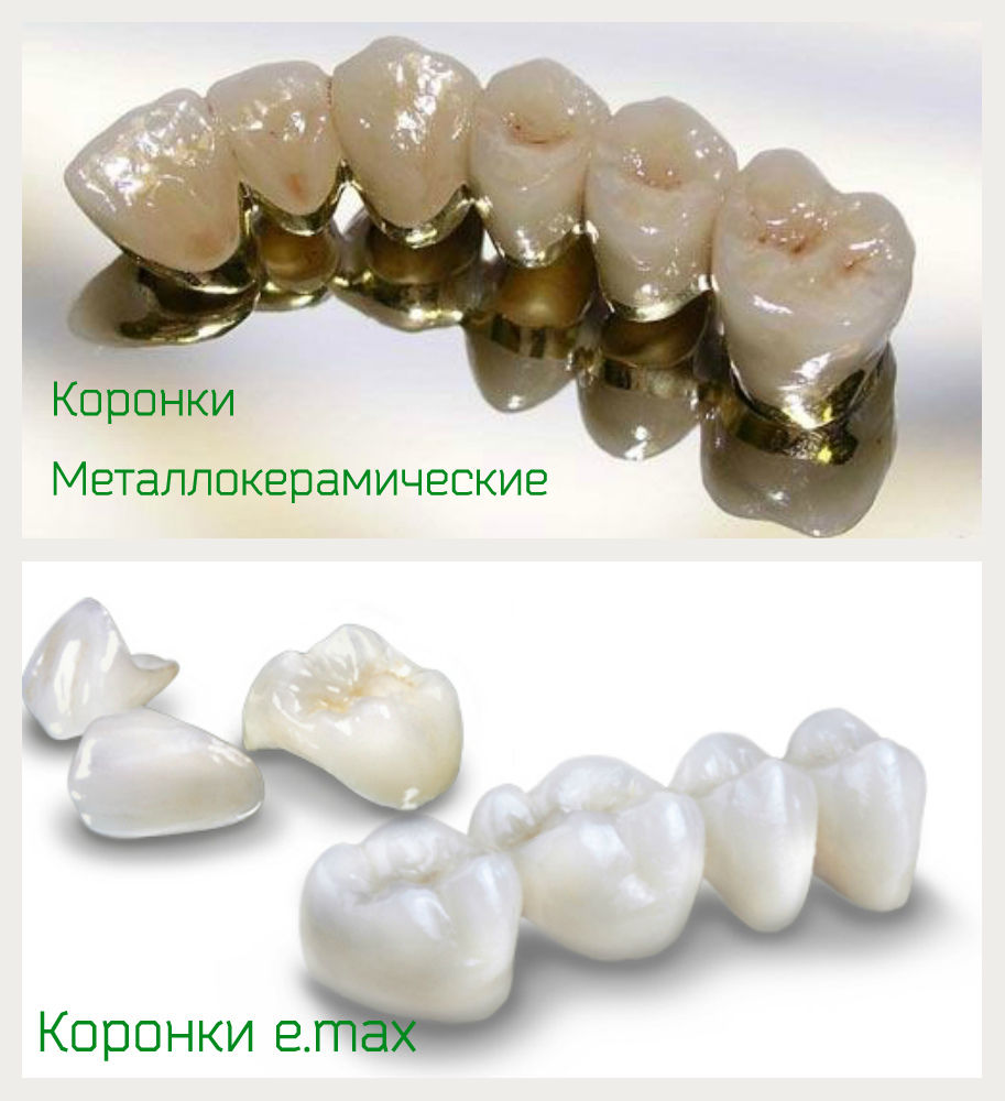 Коронки Е-Макс