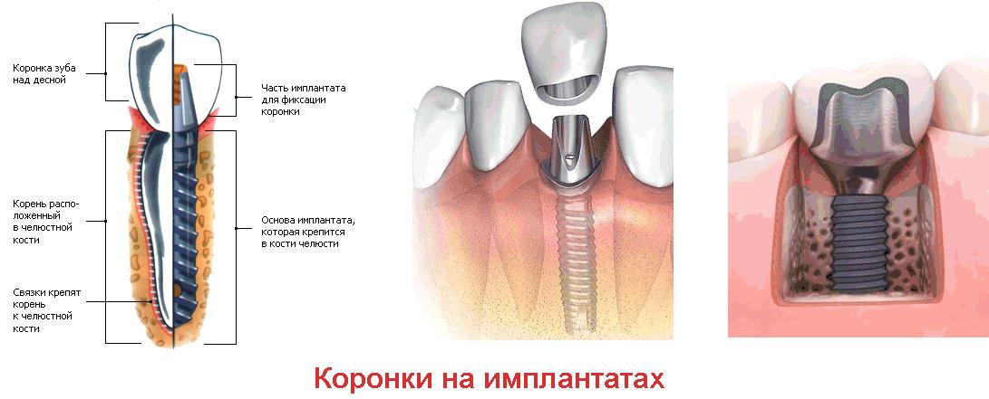 коронки на имплантах