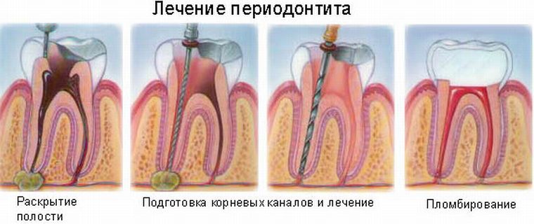 Лечение периодонтита