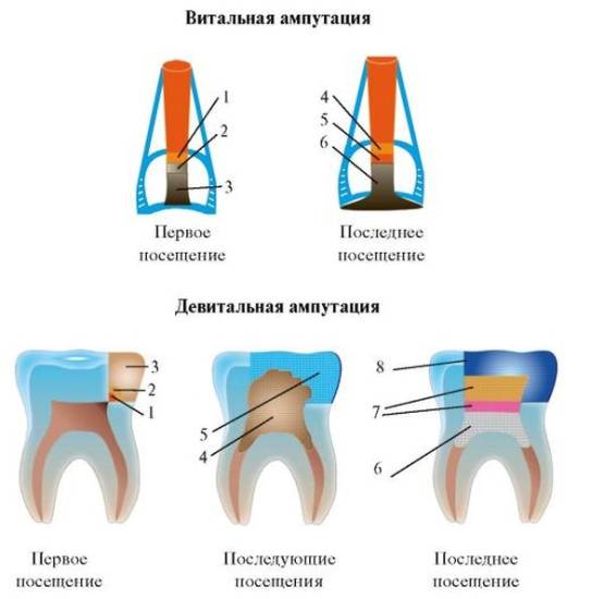 Ампутация