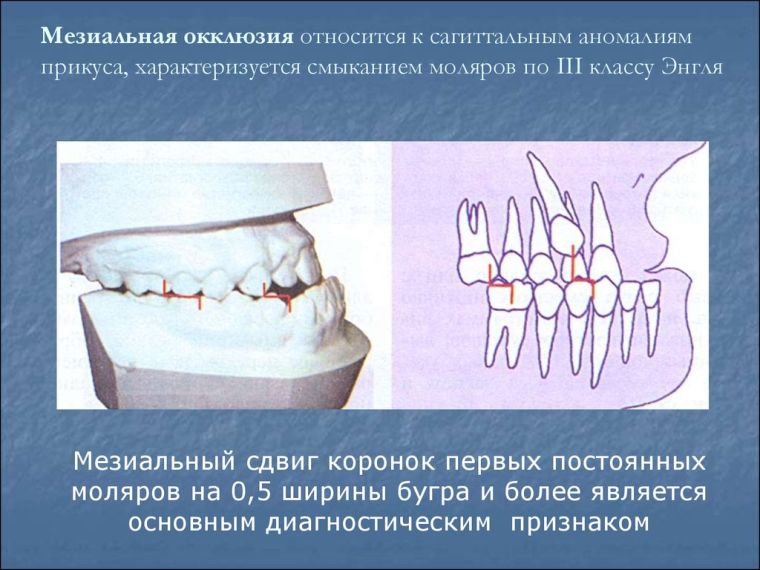 окклюзия мезиальная
