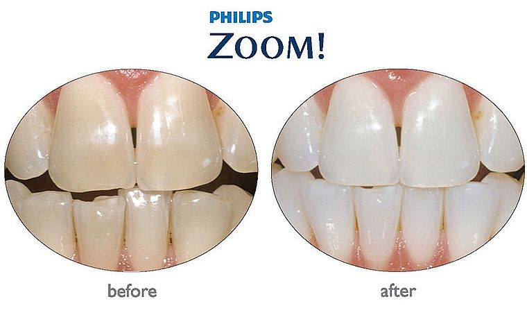 результат отбеливания Philips ZOOM! QuickPro